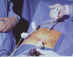 Laparascopic Cholycystectomy Laparascopic Cholycystectomy