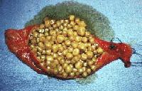 Cholesterol Gallstones