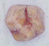 Calcium Carbonate Stones gallstones gallstone