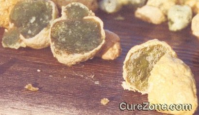 Click Here to see more gallstones and liver stones pictures ....