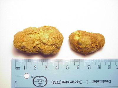 gallstone 4.5cm long result of liver cleanse liver flush