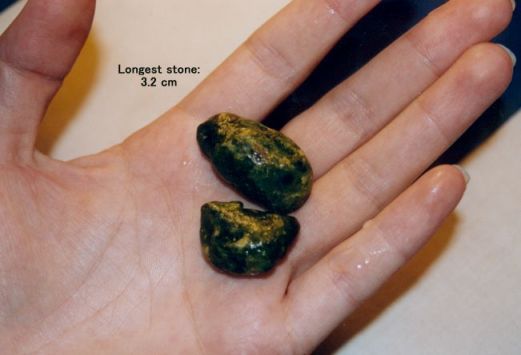 Large Cholesterol Gallstone