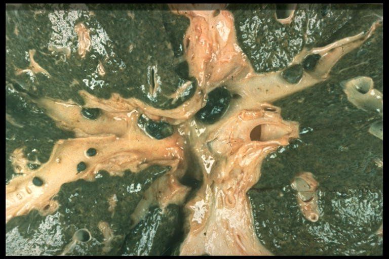 Click Here To See the NEXT image ( 3 ) (Intrahepatic Stones  - Liver - Bile Ducts, Stones Can be easily cleansed - Liver Cleanse - Flush) 