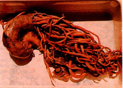 Click Here To See the NEXT image ( 22 ) ( Ascaris Lumbricoides - round worm - human intestinal parasites ) 