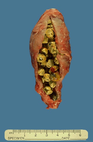 gallstones.jpg (39099 bytes)