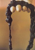 Mucoid Plaque. Photo from Dr. Jensen's  Bowel Management Book