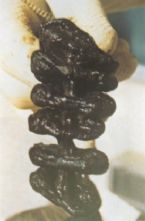 Mucoid Plaque. Photo from Dr. Jensen's  Bowel Management Book