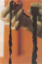 Mucoid Plaque. Photo from Dr. Jensen's  Bowel Management Book