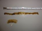 intestinal worms after enema