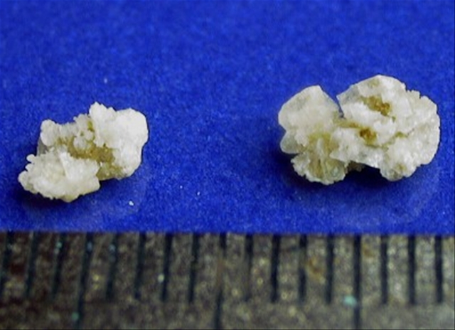Kidney Stone 1a 2 Kidney Stone 1a 2