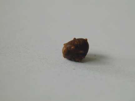 Kidney Stone side view 5 30 0 Kidney Stone side view 5 30 0