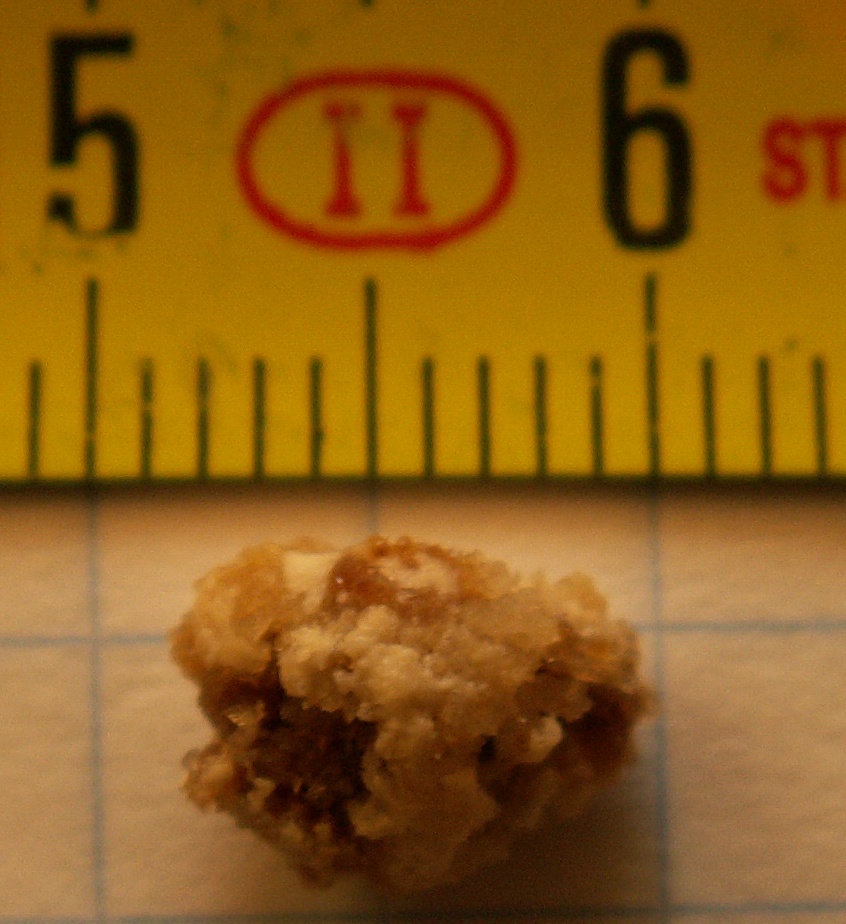 Nefrolit kidney stone Nefrolit kidney stone