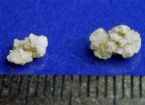 Kidney Stone 1a 2 ... (Click to enlarge)