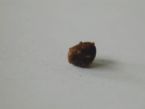 Kidney Stone side view 5 30 0 ... (Click to enlarge)