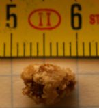 Nefrolit kidney stone ... (Click to enlarge)