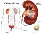 kidney stone ... (Click to enlarge)