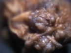 kidney stone ceace 4b64