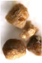 kidney stones several brown