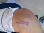 Surgery to repair torn elbow tendon ... (Click to enlarge)