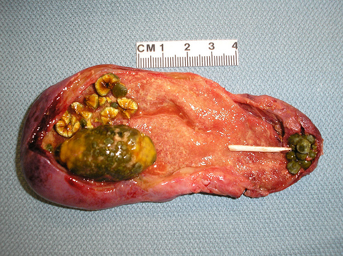 //www.curezone.org/upload/Liver_Flush/Telman/Blog/3952947457_36cc8c9675.jpg