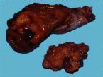 gallbladder_removed