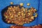 liver_gallbladder/gallbladder_removed