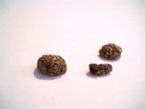 liver_gallbladder/gallbladder_removed