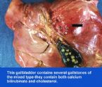 gallbladder_removed
