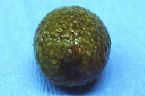 gallstones from the gallbladder