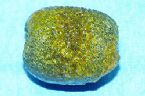 gallstones from the gallbladder
