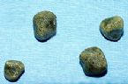 gallstones from the gallbladder