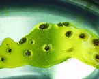 gallstones from the gallbladder