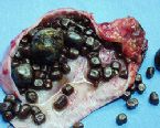 gallstones from the gallbladder