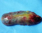 gallstones from the gallbladder