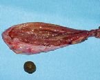 gallstones from the gallbladder