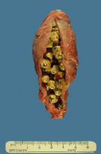 gallstones from the gallbladder