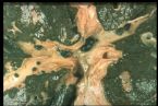 intrahepatic stones