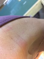 SEVEN MONTHS LATER, same back and shoulder area. ... (Click to enlarge)