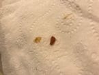 Is this liver fluke ... (Click to enlarge)