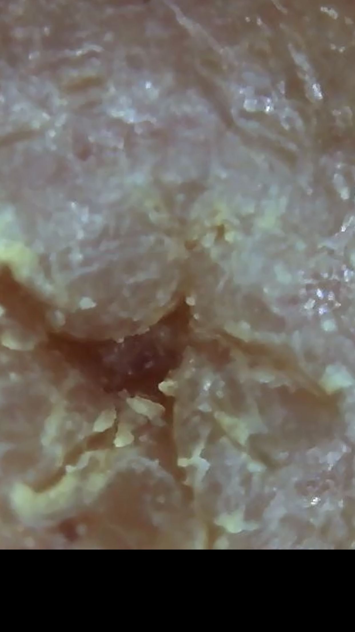 pictures of hookworms in humans pictures of hookworms in humans