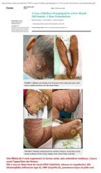 A case of Bullous Pemphigoid in a girl after the second dose of DTaP, Hib, HBV vaccines ... (Click to enlarge)