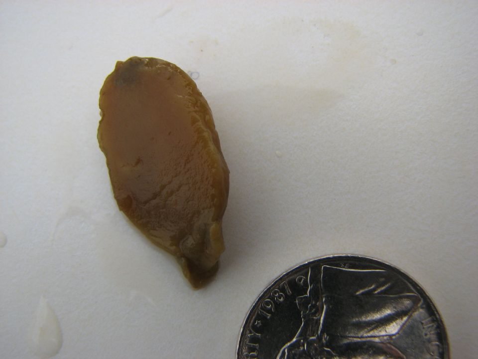 liver fluke in stool liver fluke in stool