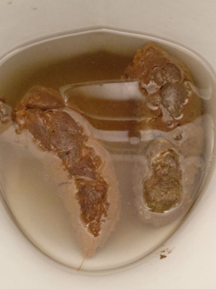 ibs parasites stool worm found spots curezone disgusting log lot