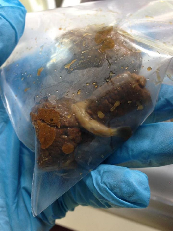 Pictures of parasite eggs in human feces