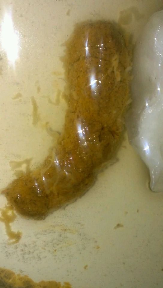 unknown parasite in stool On CureZone Image Gallery