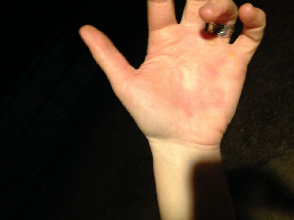 Image: parasitical infection on palm Image: parasitical infection on palm