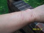 Parasite Entry Wounds Cuts  ... (Click to enlarge)