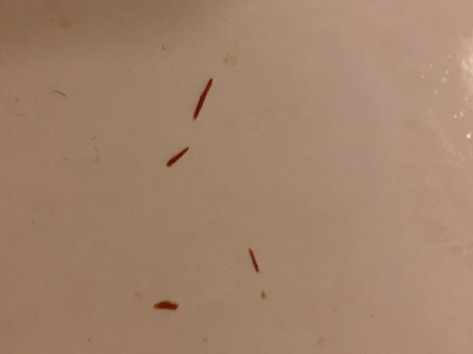 liver fluke in stool liver fluke in stool