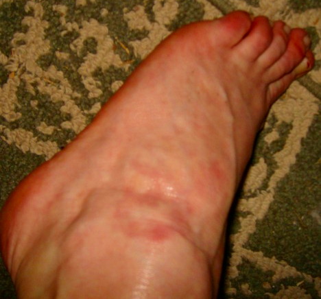 covid rash on foot covid rash on foot