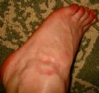 other foot rash same person